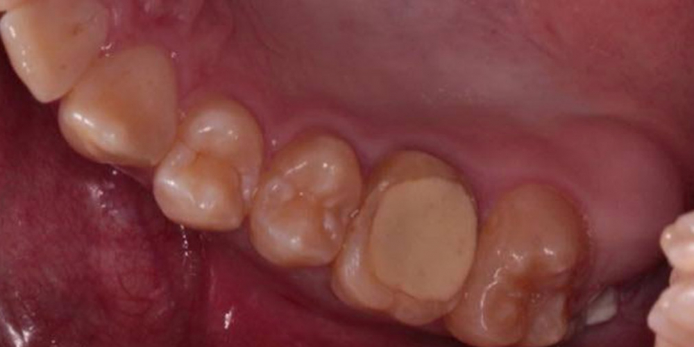 Пациент имел весьма разрушенный зуб и плоскую (как и у большинства людей) пломбы, без мало мальски выраженных бугров и соответственно не пригодный для эффективного пережёвывания пищи. Результат восстановления зуба композитной накладкой