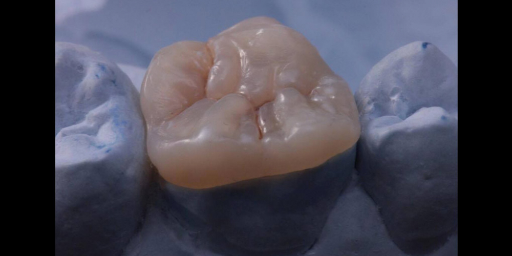 Примерка накладки на гипсовой модели. Результат восстановления зуба композитной накладкой