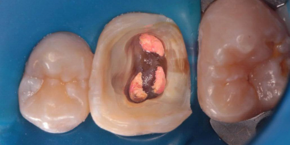 Было проведено эндодонтическое лечение корневых каналов под микроскопом и предварительное восстановление зуба под накладку. Результат восстановления зуба композитной накладкой